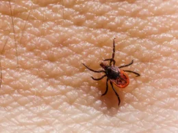 Another Karachi resident has died from Congo virus