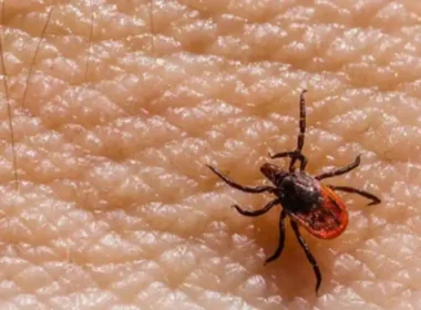 Another case of Congo virus has been reported in Karachi