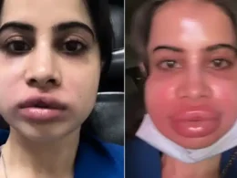 Uorfi Javed's lip fillers treatment