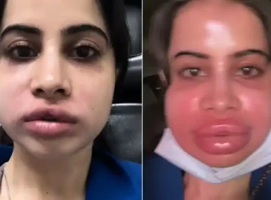 Uorfi Javed's lip fillers treatment