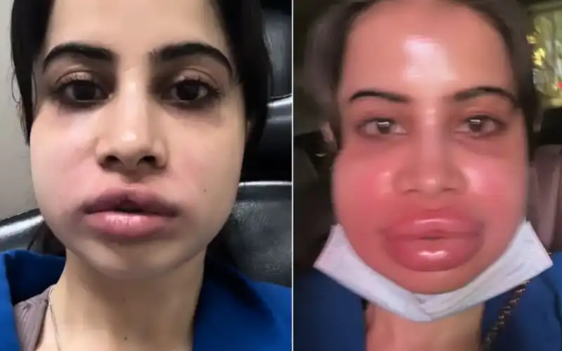 Uorfi Javed's lip fillers treatment