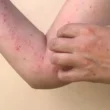 Monkeypox has begun to spread rapidly across the country