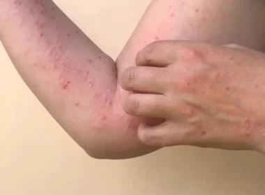 Monkeypox has begun to spread rapidly across the country