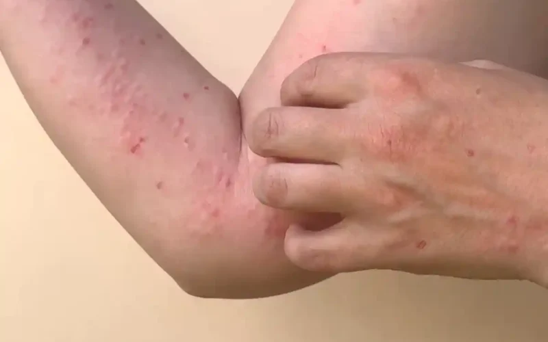 Monkeypox has begun to spread rapidly across the country