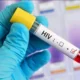 Rise in HIV cases in Sindh